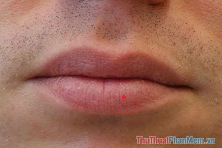 Nốt ruồi trên môi: Ý nghĩa tốt hay xấu? Có nên giữ lại hay loại bỏ?
