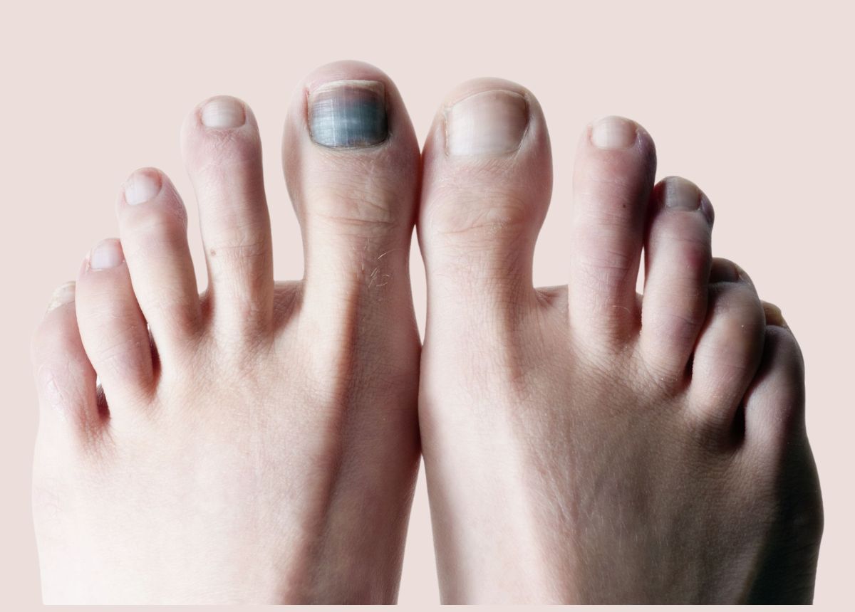 'Understanding Blackened Toe Nails Causes and Remedies Mytour'