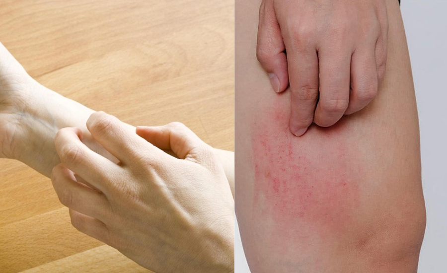 Dealing with Winter Itch Causes and Solutions