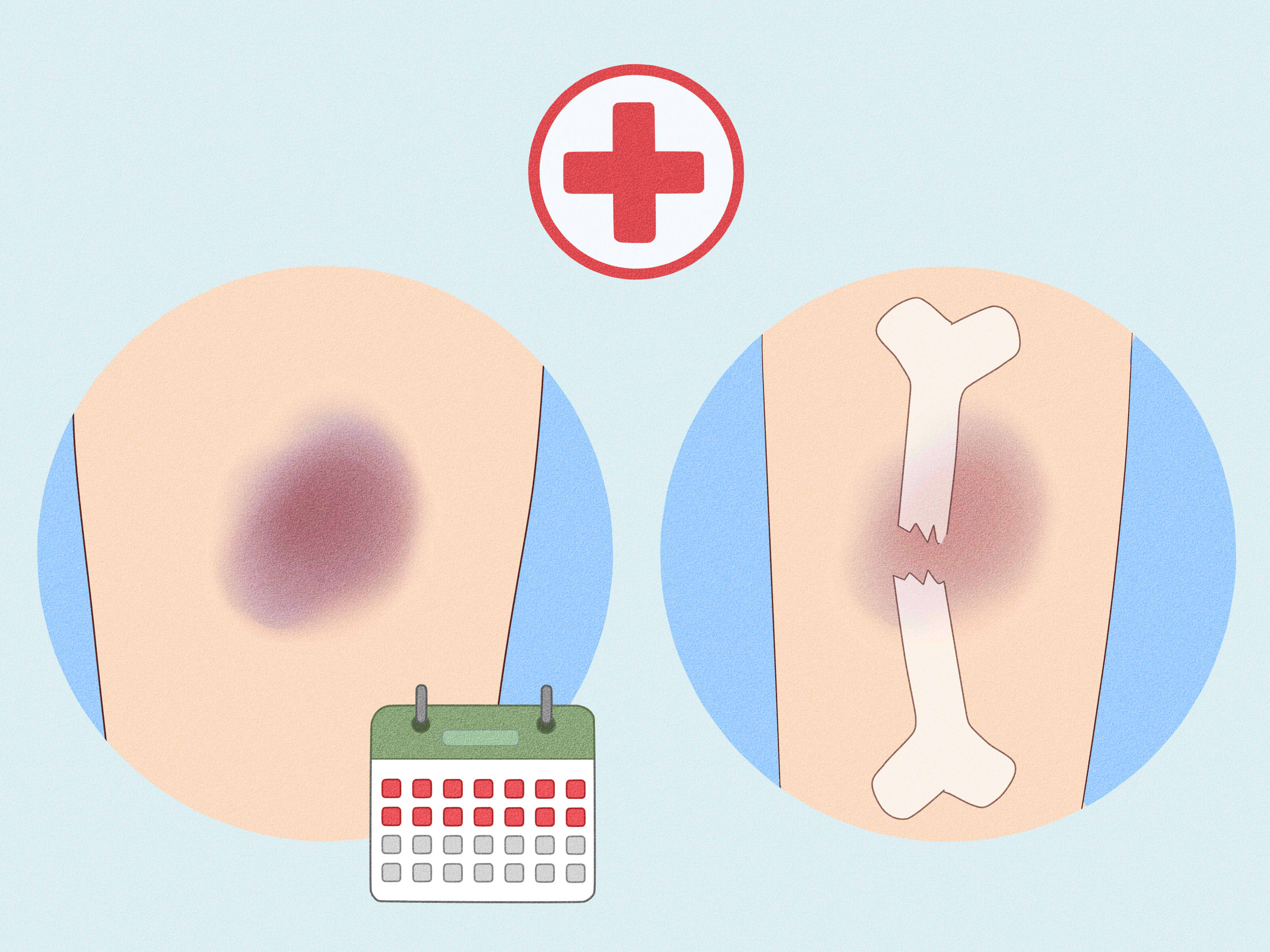 Effective Ways to Heal Bruises Faster Using Toothpaste