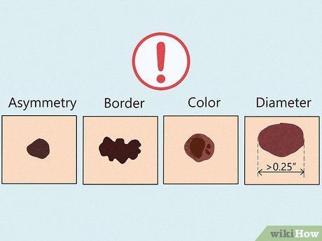 Understanding the Significance of Hand Moles: Interpretation ...