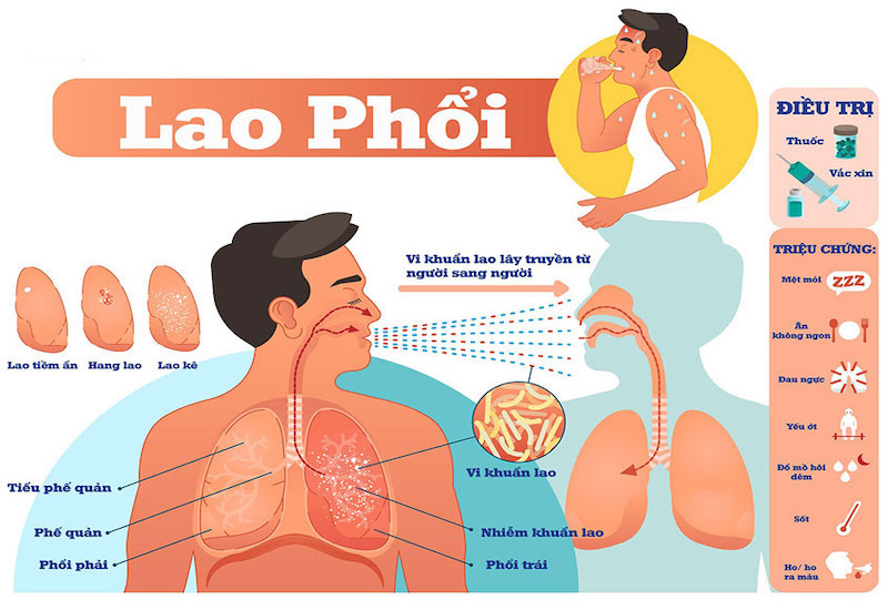 Phòng Ngừa Bệnh Lao Phổi