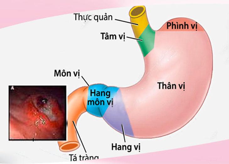 Top 8 Symptoms of Gastric Antrum Inflammation - Mytour.vn