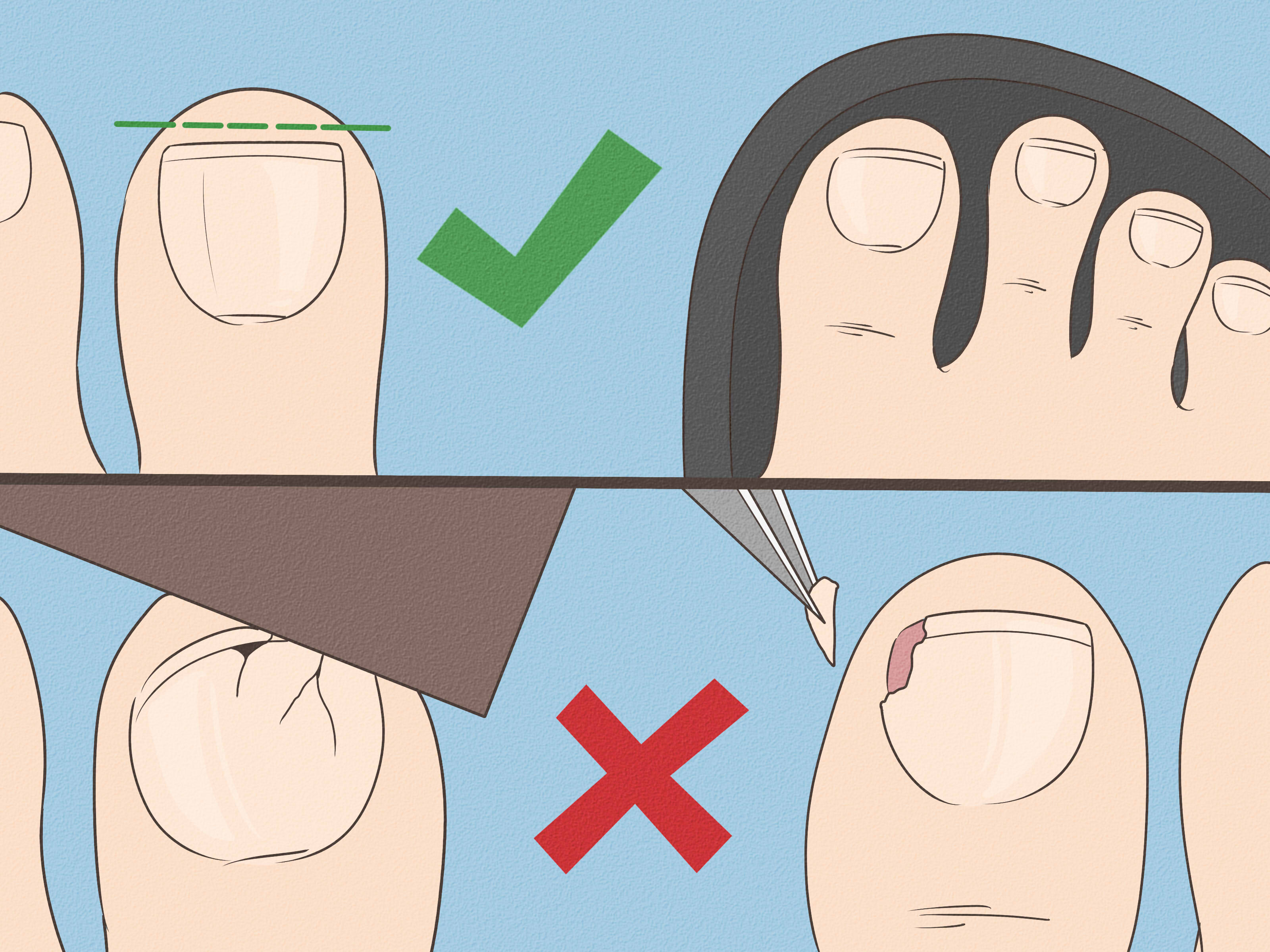 Breathtaking Can Ingrown Toenails Heal On Their Own Design in 4K Breathtaking Can Ingrown Toenails Heal On Their Own Design in 4K