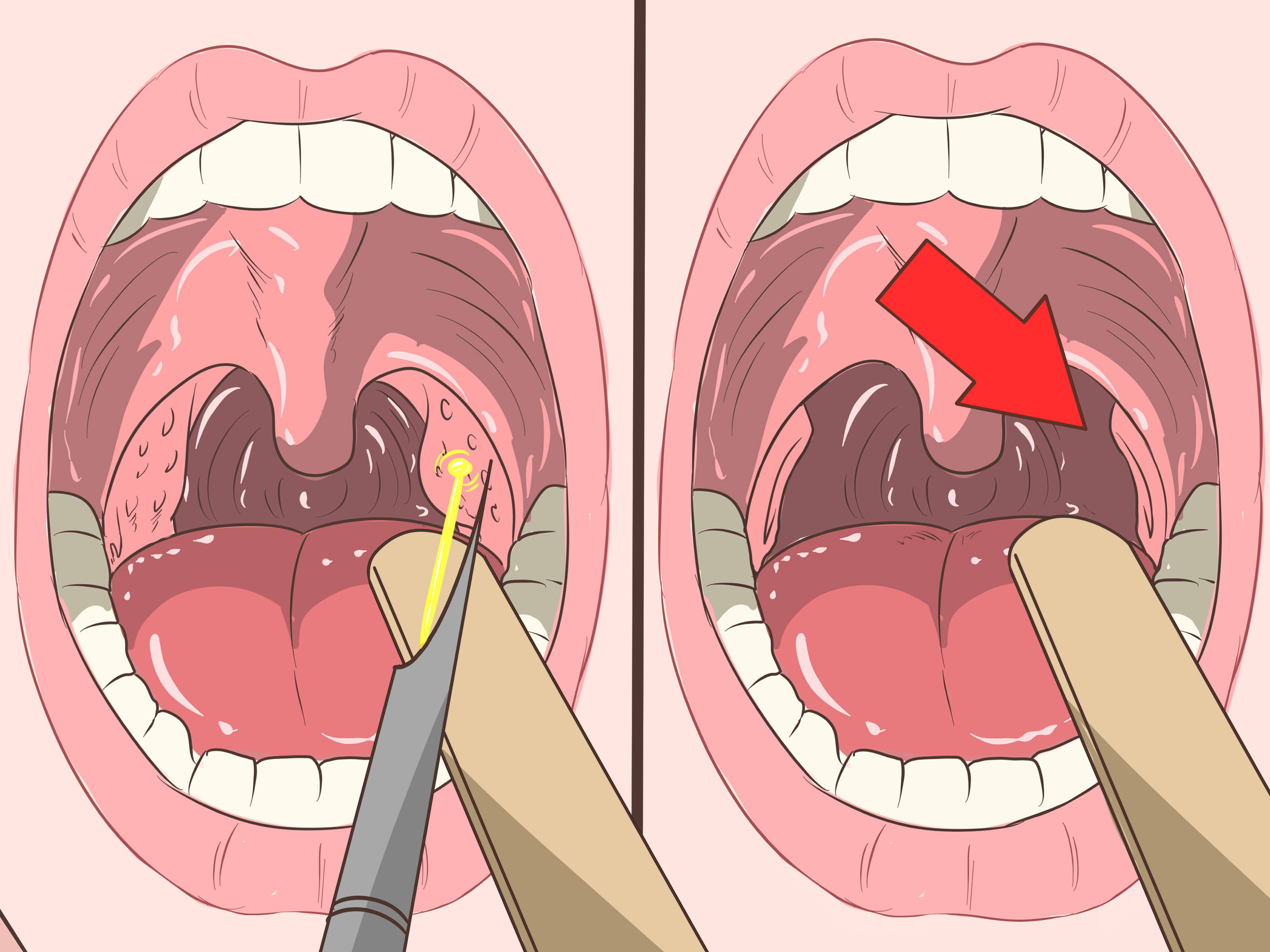 Cách loại bỏ sỏi amidan hiệu quả
