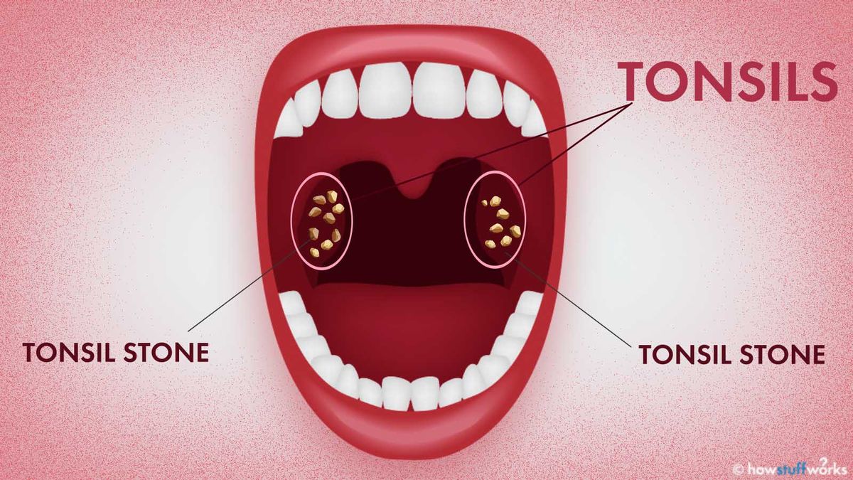 Curious about tonsil stones? Here’s what you need to know! Tonsil ...